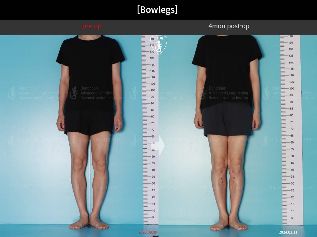 Before and after adult bowlegs, case 17962599, image 2, Dr. Donghoon institute (DALRI)