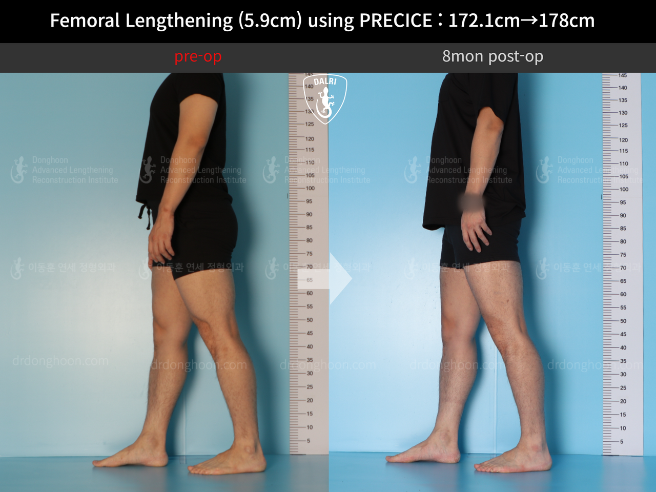 Before and after cll precice, case 13848850, image 5, Dr. Donghoon institute (DALRI)