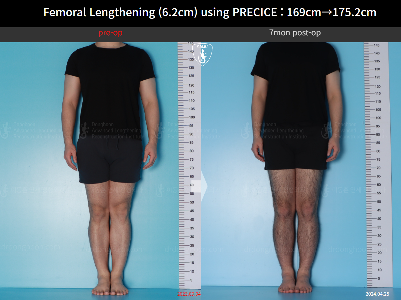 Before and after cll precice, case 20671201, image 1, Dr. Donghoon institute (DALRI)