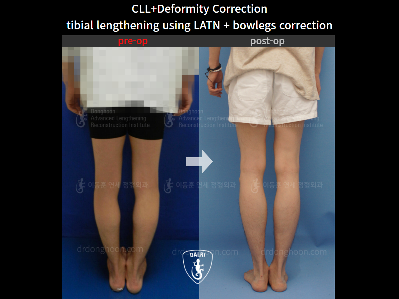 Before and after cll + deformity correction, case 4567585, image 6, Dr. Donghoon institute (DALRI)