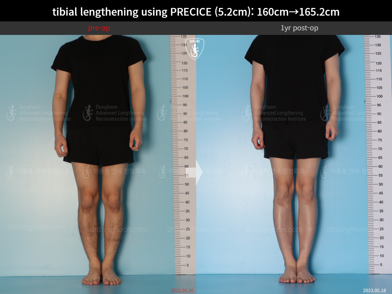 Before and after cll precice, case 15213098, image 1, Dr. Donghoon institute (DALRI)