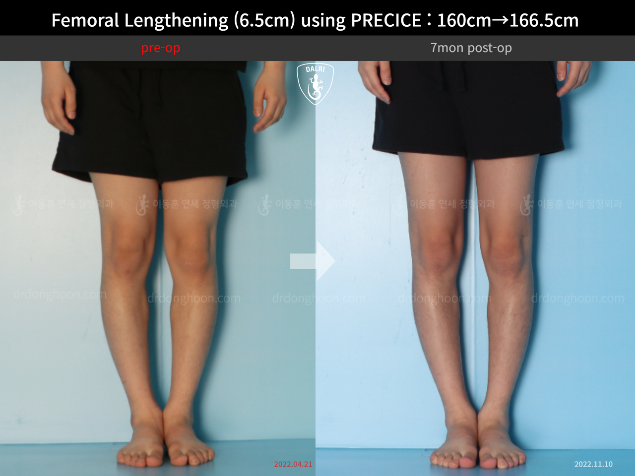 Before and after cll precice, case 13413485, image 7, Dr. Donghoon institute (DALRI)