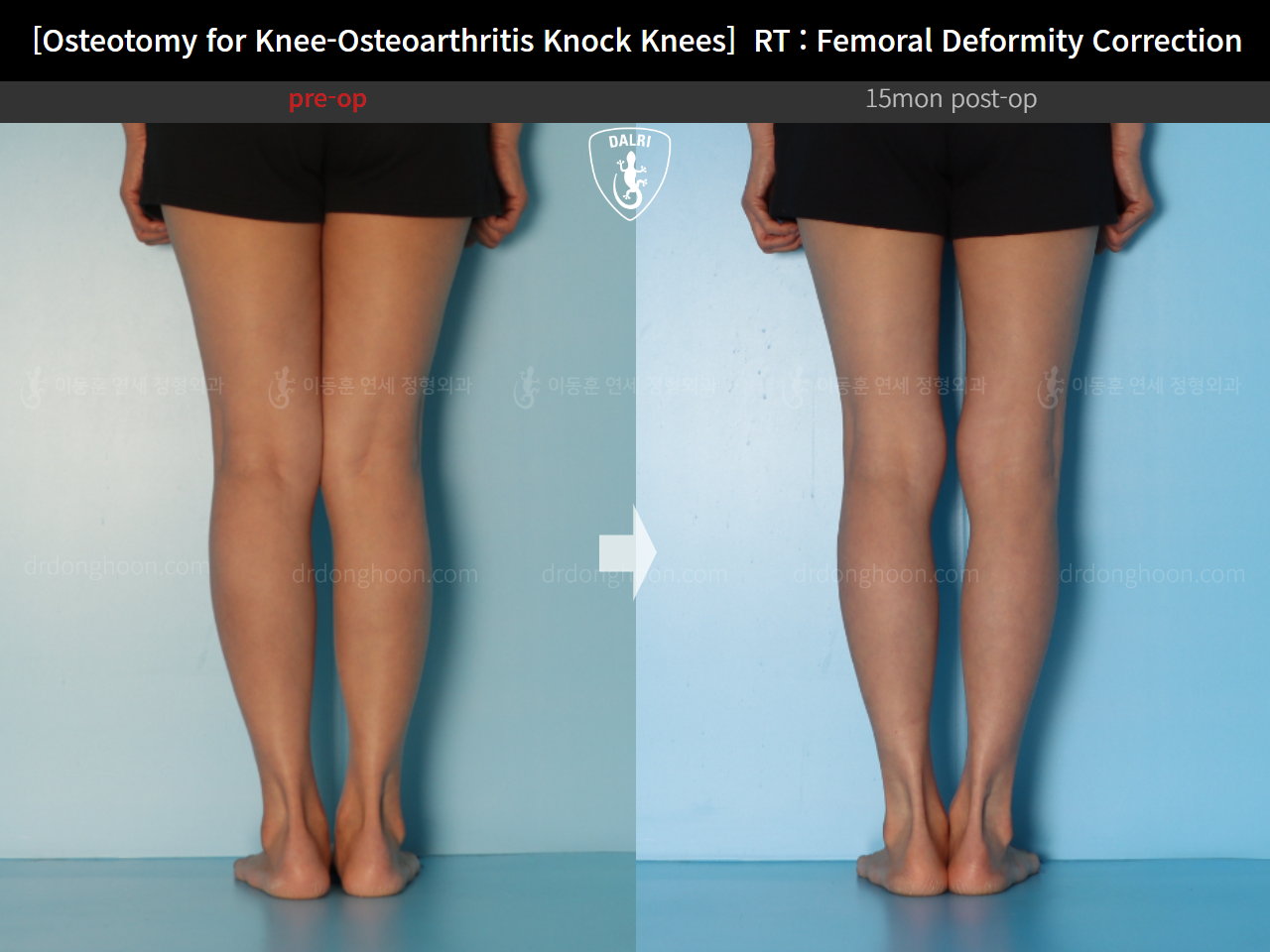 Before and after osteotomy for knee osteoarthritis, case 14462707, image 8, Dr. Donghoon institute (DALRI)