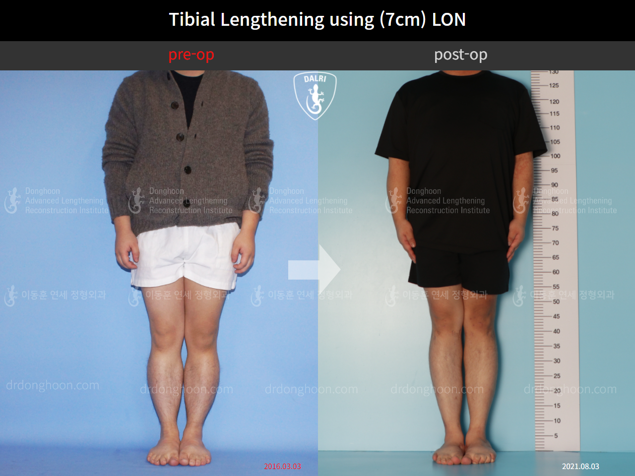 Before and after cll lon, case 10452499, image 1, Dr. Donghoon institute (DALRI)