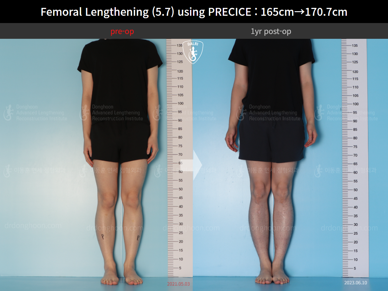 Before and after cll precice, case 15417090, image 1, Dr. Donghoon institute (DALRI)