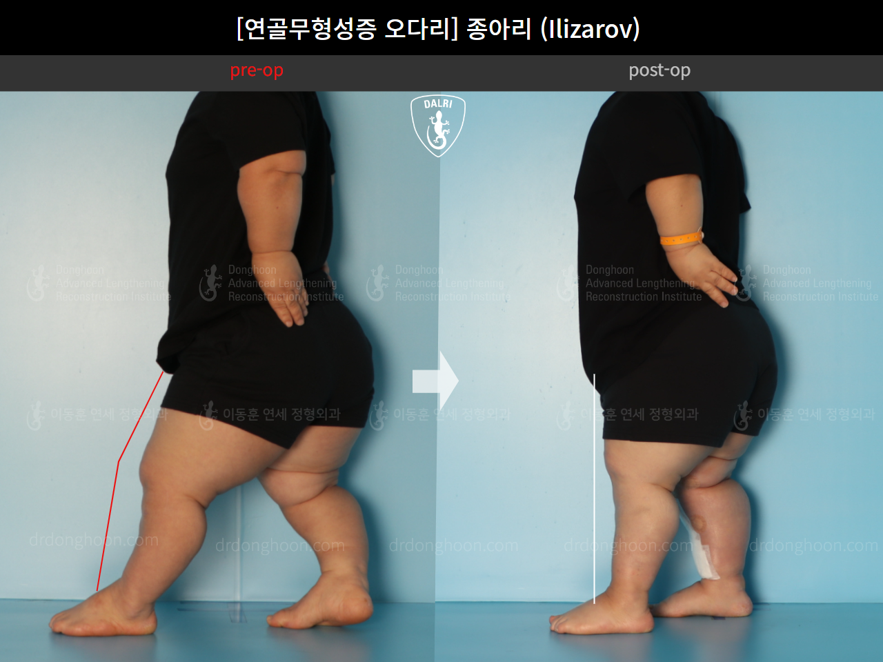 Before and after congenital condition, case 18077774, image 3, Dr. Donghoon institute (DALRI)