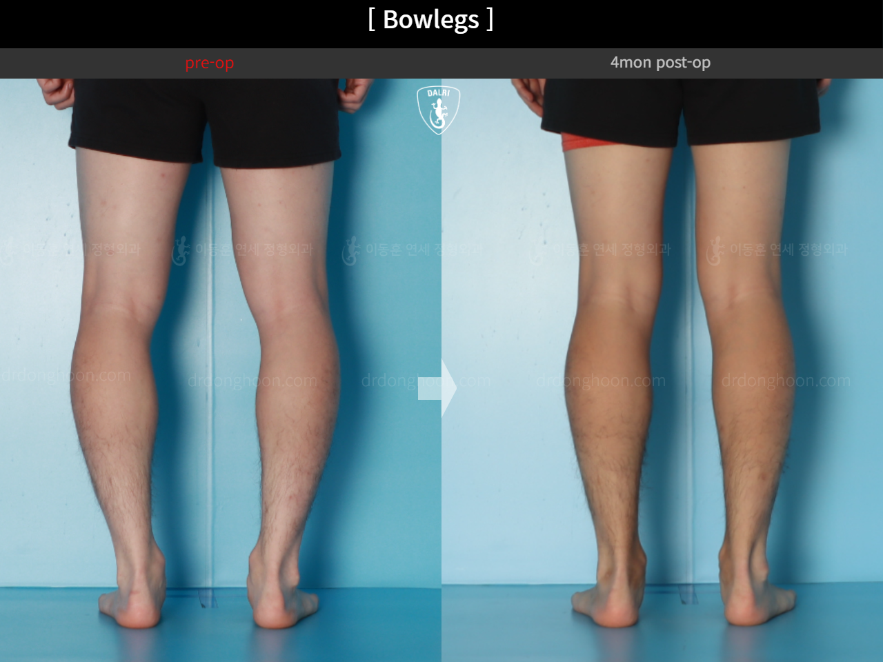 Before and after adult bowlegs, case 18479637, image 10, Dr. Donghoon institute (DALRI)