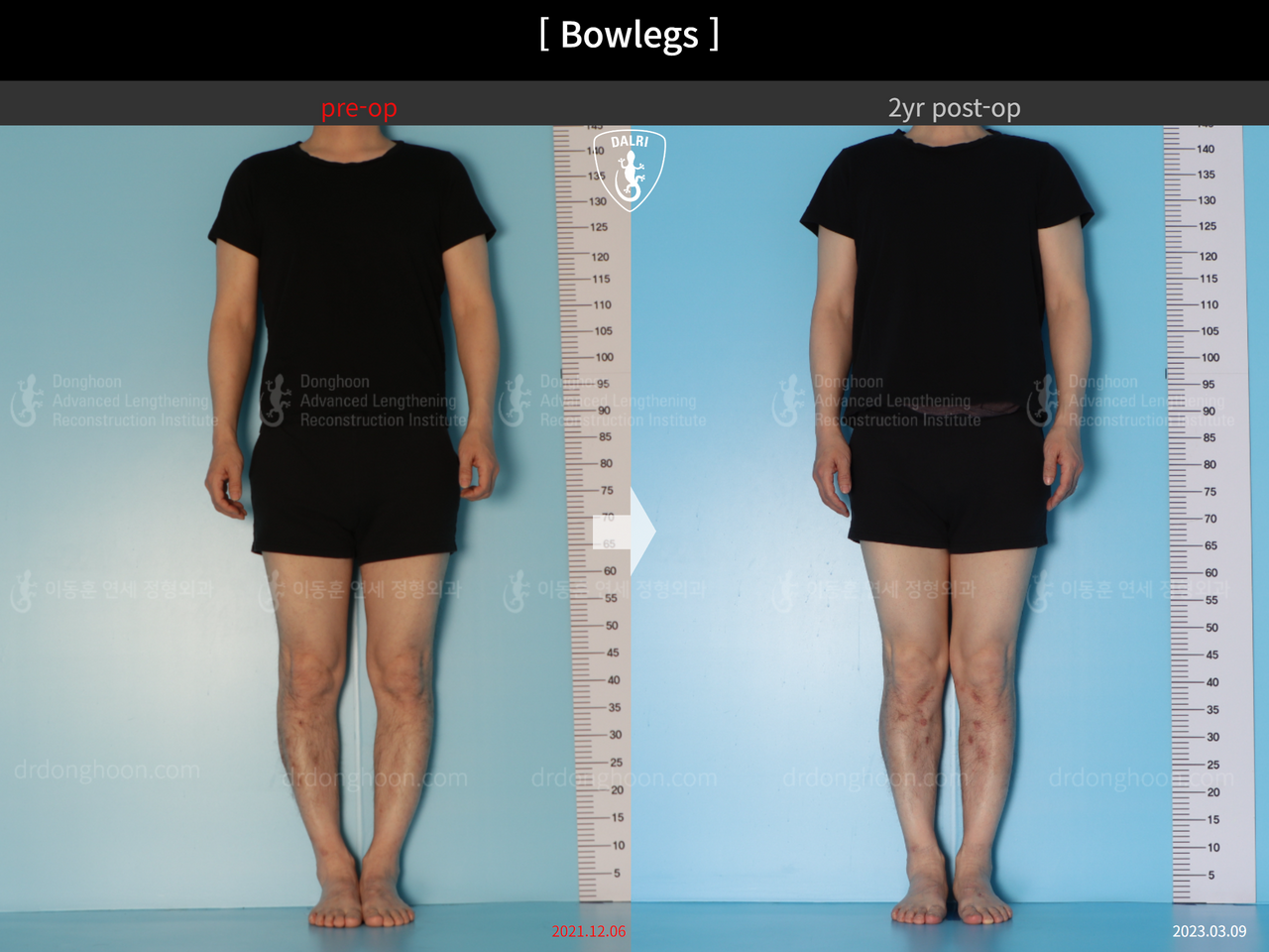 Before and after adult bowlegs, case 14445187, image 1, Dr. Donghoon institute (DALRI)