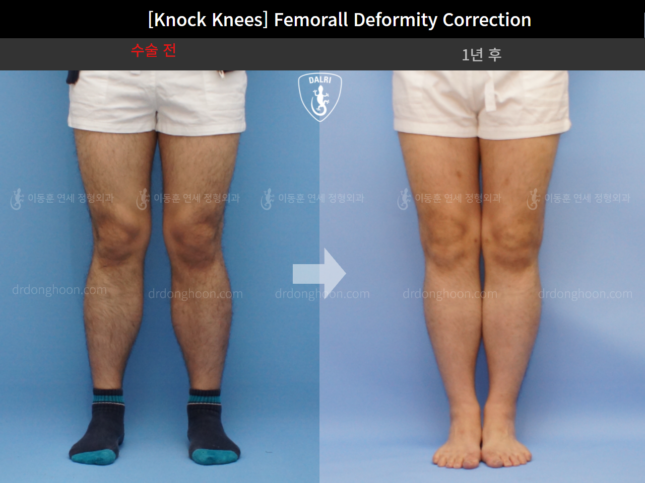 Before and after adult knock knees, case 4310847, image 3, Dr. Donghoon institute (DALRI)
