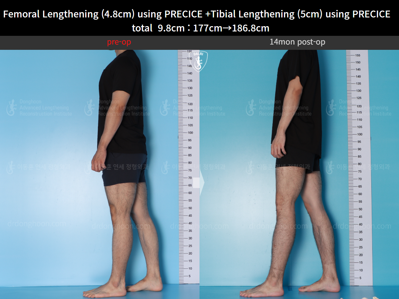 Before and after cll precice, case 16780196, image 5, Dr. Donghoon institute (DALRI)
