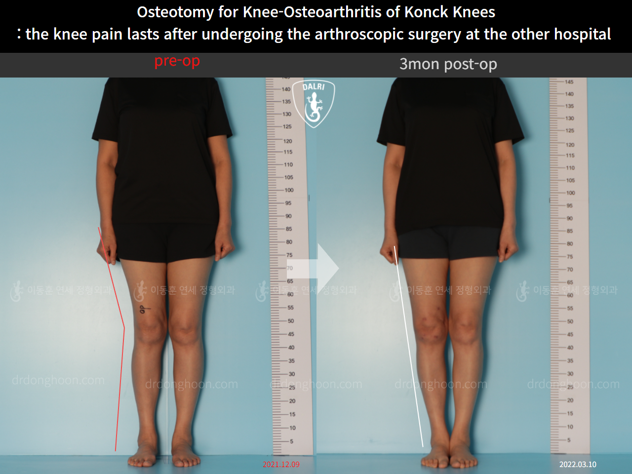 Before and after osteotomy for knee osteoarthritis, case 10664630, image 1, Dr. Donghoon institute (DALRI)