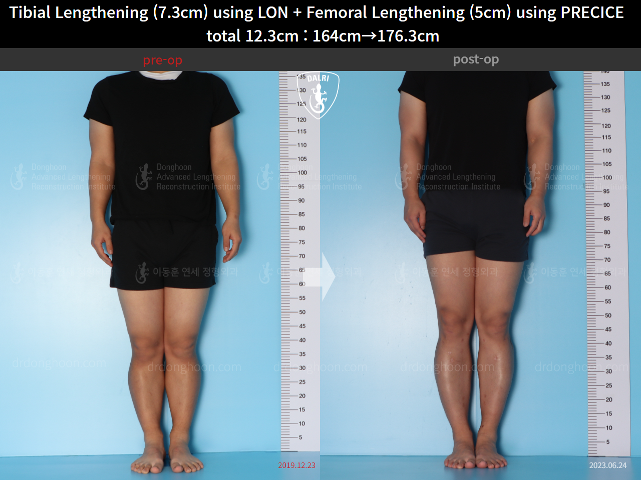 Before and after cll precice, case 15592732, image 1, Dr. Donghoon institute (DALRI)