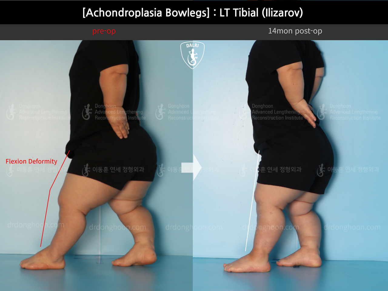 Before and after congenital condition, case 14296141, image 3, Dr. Donghoon institute (DALRI)