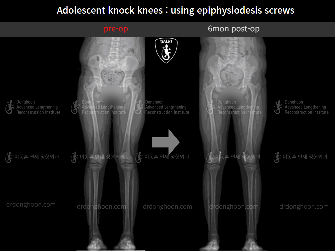 Before and after paediatric & adolescent knock knees, case 9626556, image 7, Dr. Donghoon institute (DALRI)