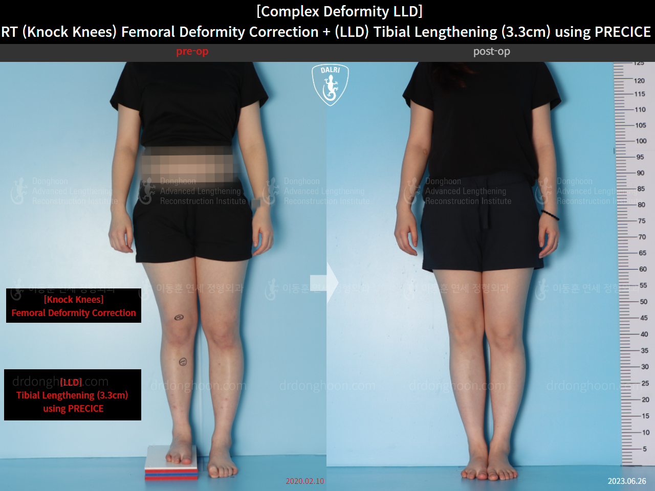 Before and after adult lld, case 15584036, image 1, Dr. Donghoon institute (DALRI)