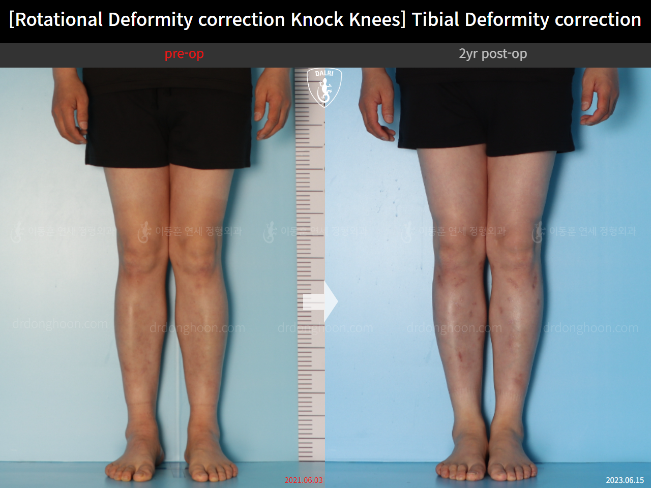 Before and after adult knock knees, case 15524370, image 5, Dr. Donghoon institute (DALRI)