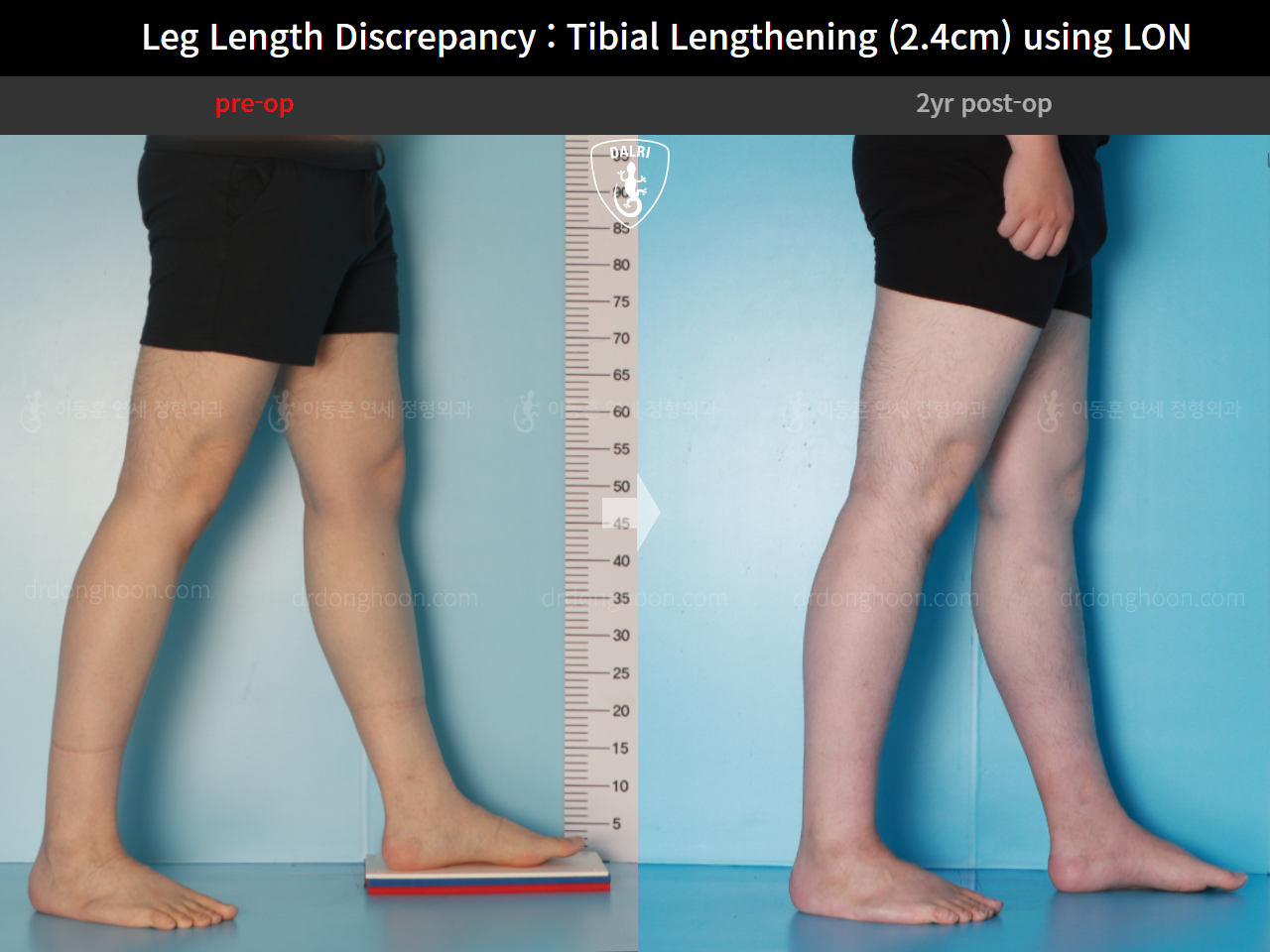 Before and after adult lld, case 15877698, image 8, Dr. Donghoon institute (DALRI)