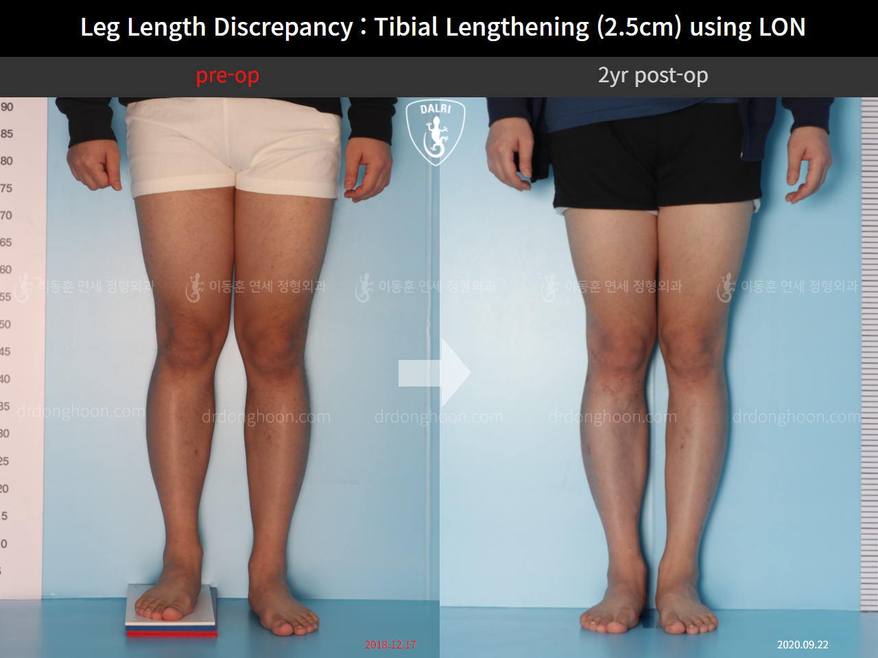 Before and after adult lld, case 9763026, image 3, Dr. Donghoon institute (DALRI)