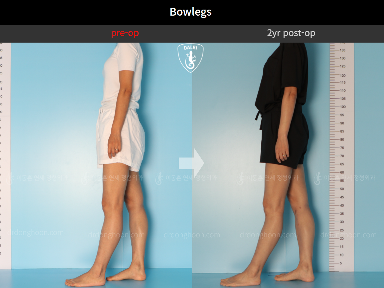 Before and after adult bowlegs, case 10023318, image 5, Dr. Donghoon institute (DALRI)
