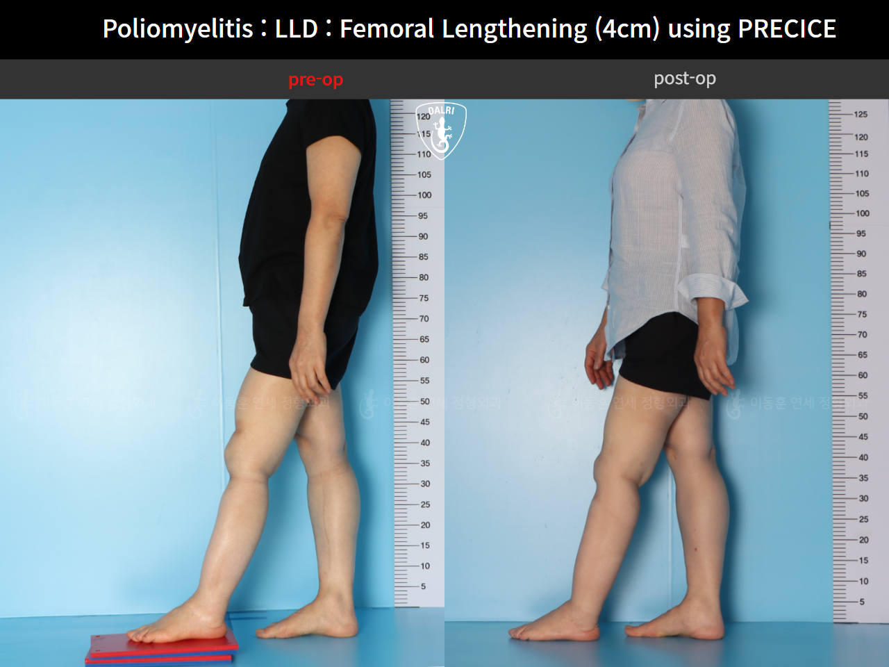 Before and after adult lld, case 91242486, image 3, Dr. Donghoon institute (DALRI)