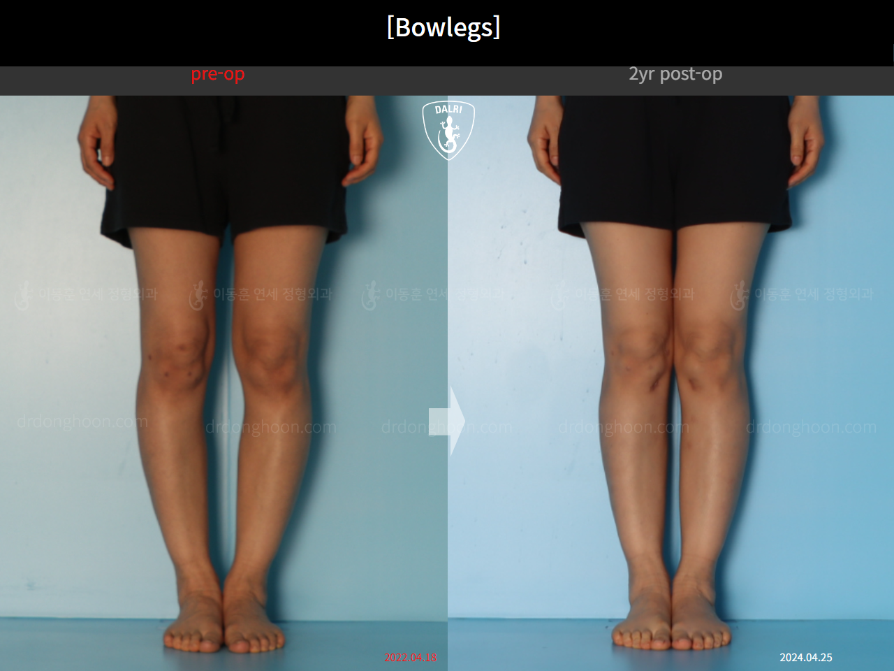 Before and after adult bowlegs, case 20942169, image 6, Dr. Donghoon institute (DALRI)