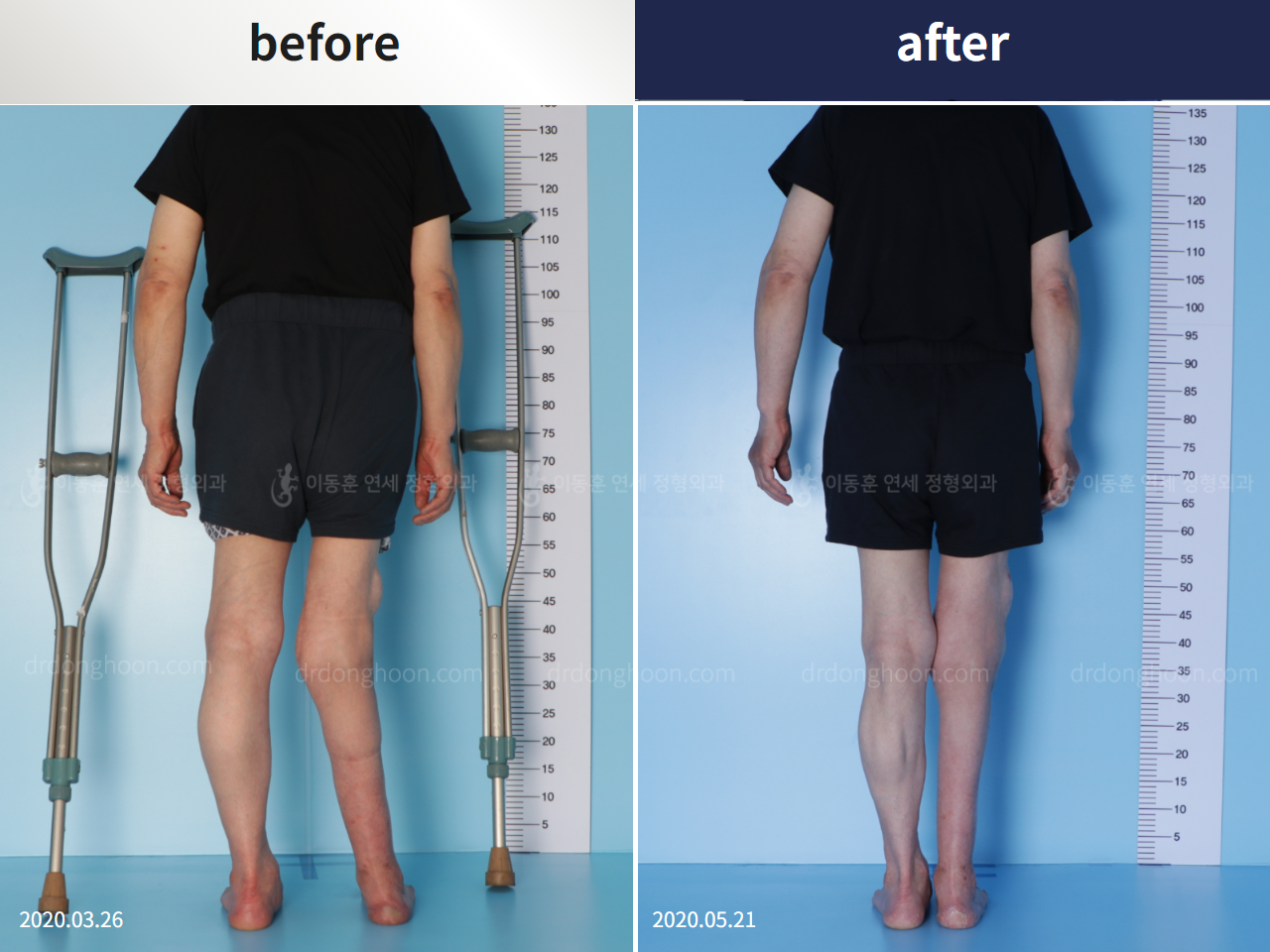 Before and after congenital condition, case 4304680, image 2, Dr. Donghoon institute (DALRI)