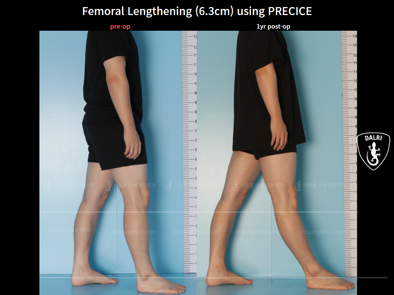 Before and after cll precice, case 7727388, image 4, Dr. Donghoon institute (DALRI)