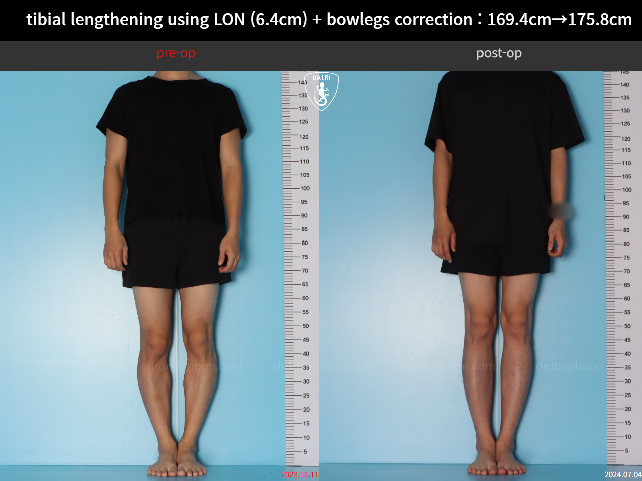 Before and after cll + deformity correction, case 36736776, image 1, Dr. Donghoon institute (DALRI)