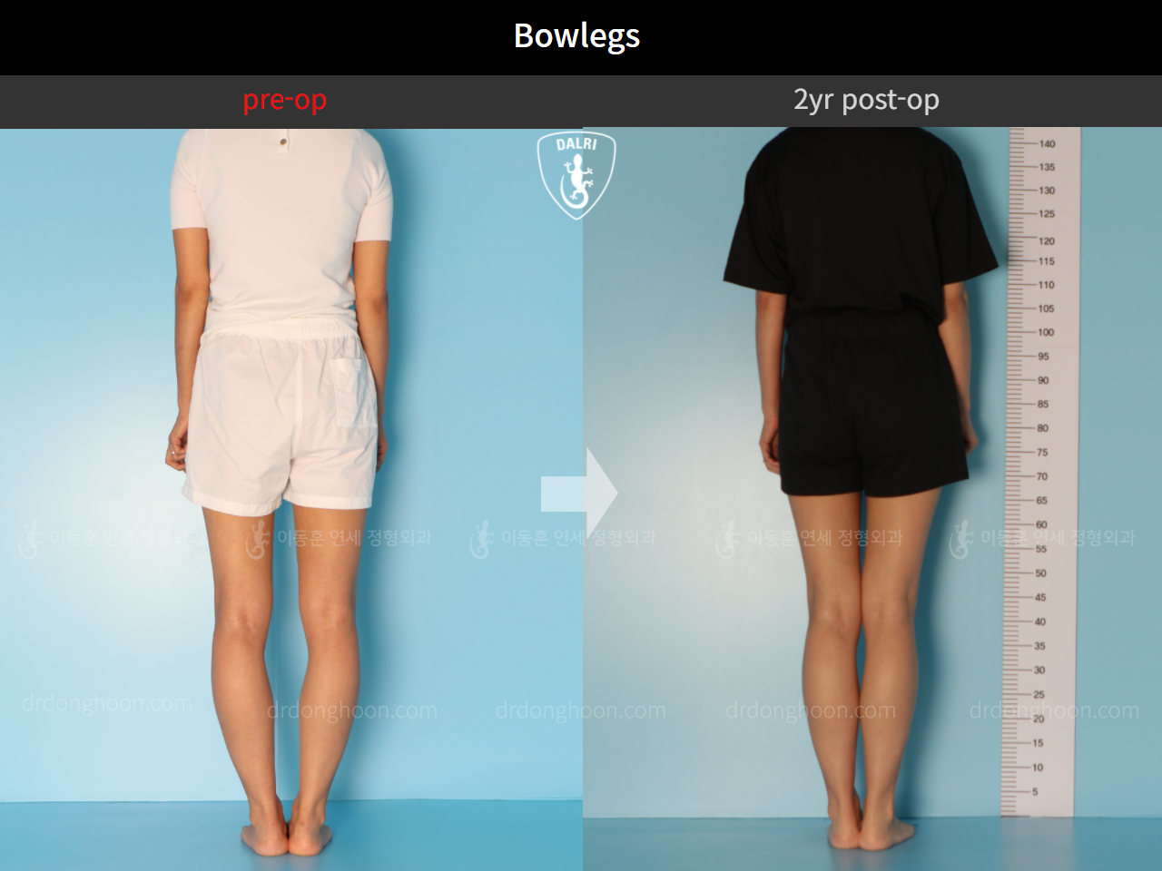 Before and after adult bowlegs, case 10023318, image 4, Dr. Donghoon institute (DALRI)