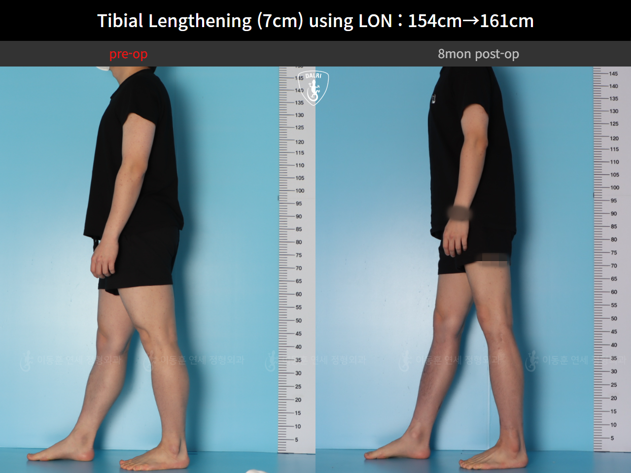 Before and after cll lon, case 127519935, image 6, Dr. Donghoon institute (DALRI)