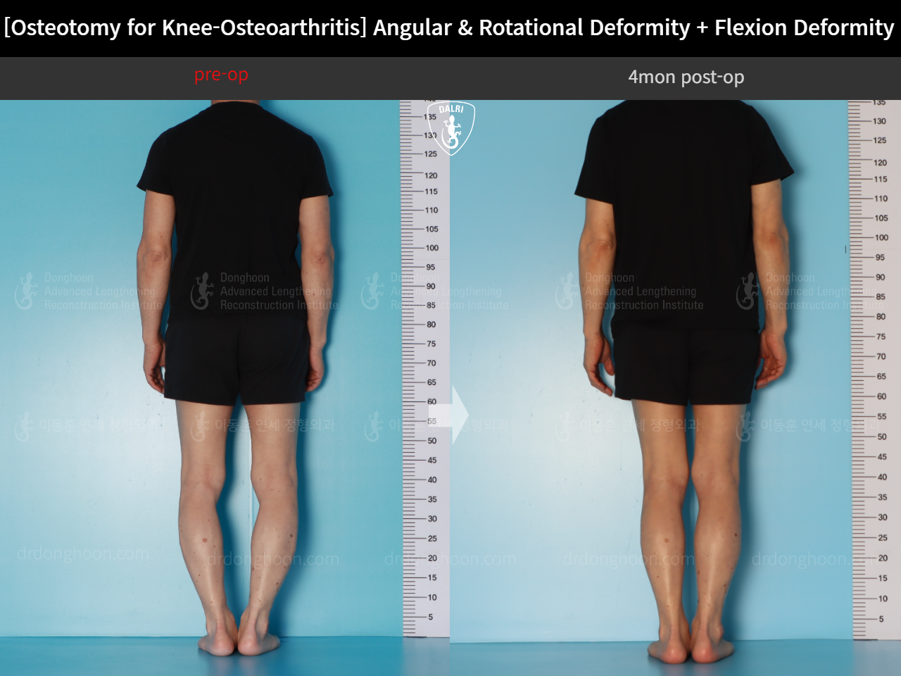 Before and after osteotomy for knee osteoarthritis, case 18162350, image 4, Dr. Donghoon institute (DALRI)