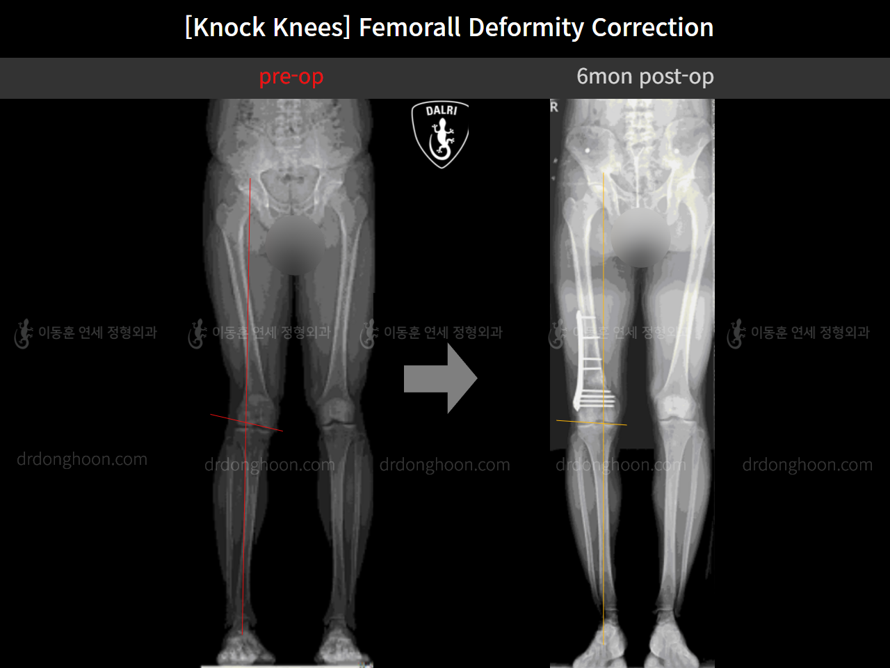 Before and after adult knock knees, case 11773301, image 7, Dr. Donghoon institute (DALRI)