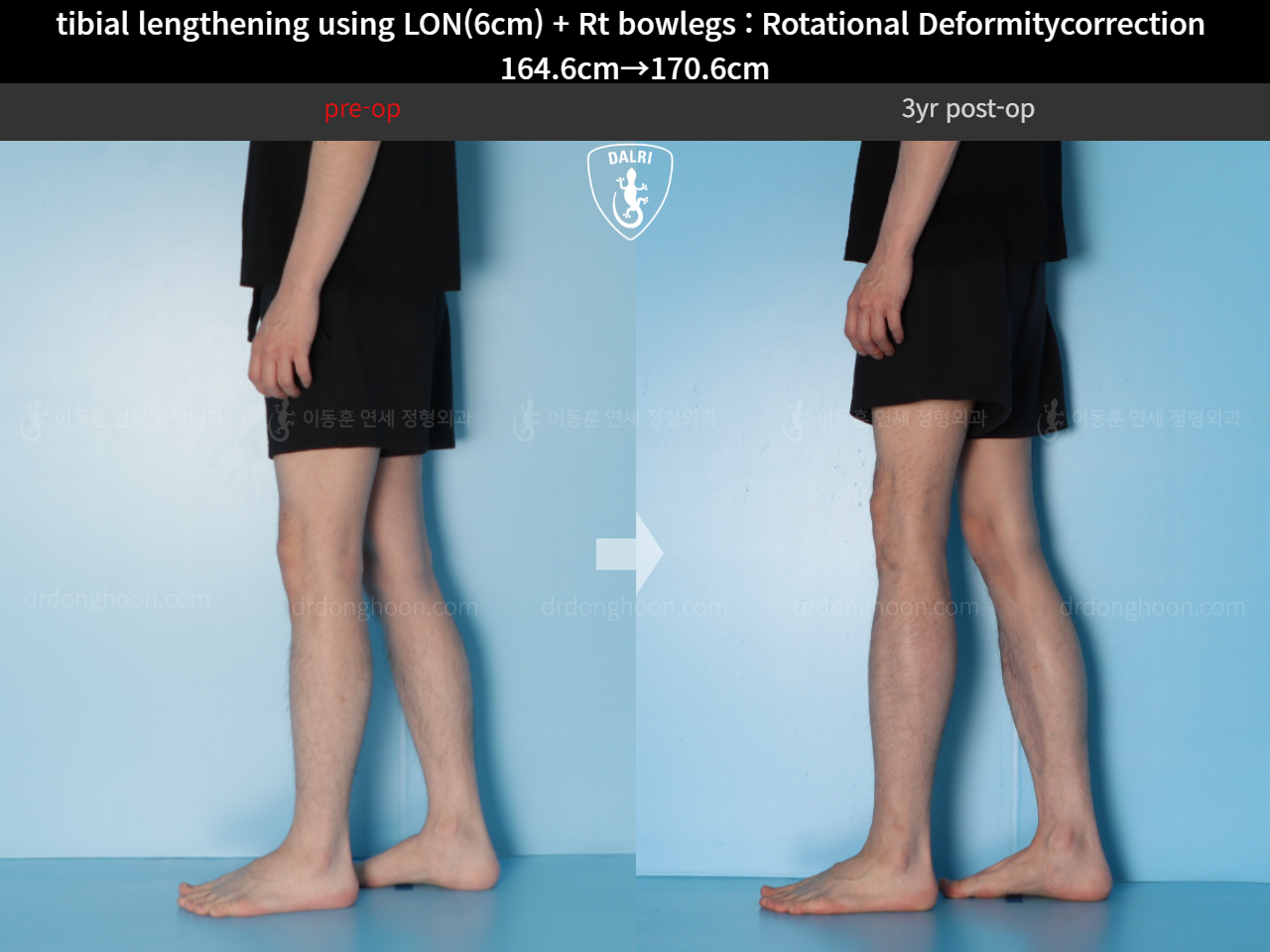 Before and after cll + deformity correction, case 15347322, image 8, Dr. Donghoon institute (DALRI)