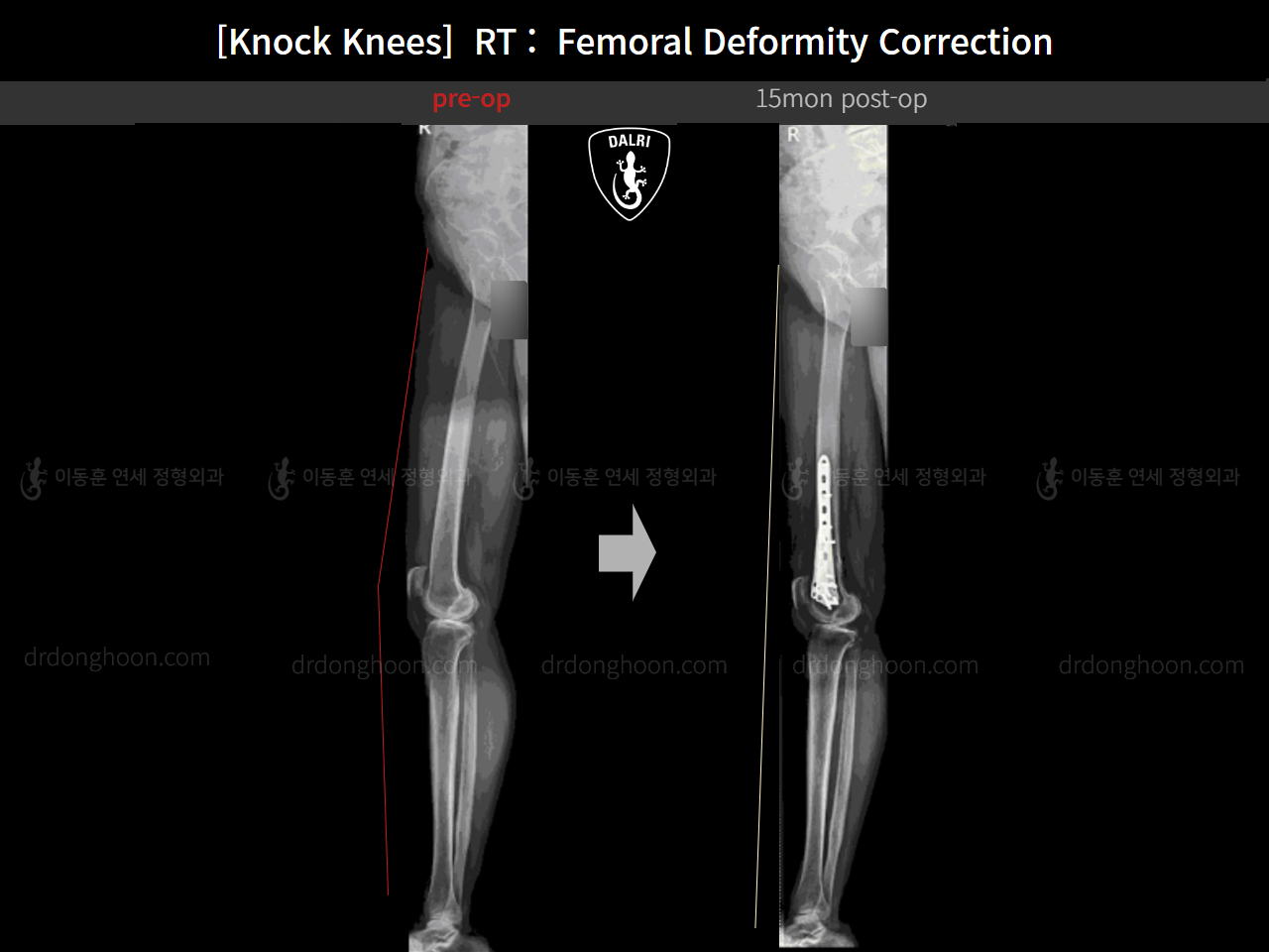Before and after adult knock knees, case 14462642, image 11, Dr. Donghoon institute (DALRI)