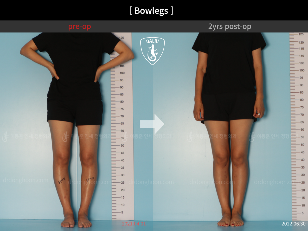 Before and after adult bowlegs, case 12060396, image 3, Dr. Donghoon institute (DALRI)