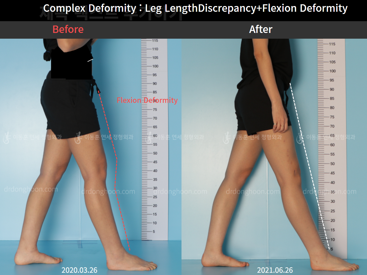 Before and after flexion deformity, case 7397575, image 1, Dr. Donghoon institute (DALRI)