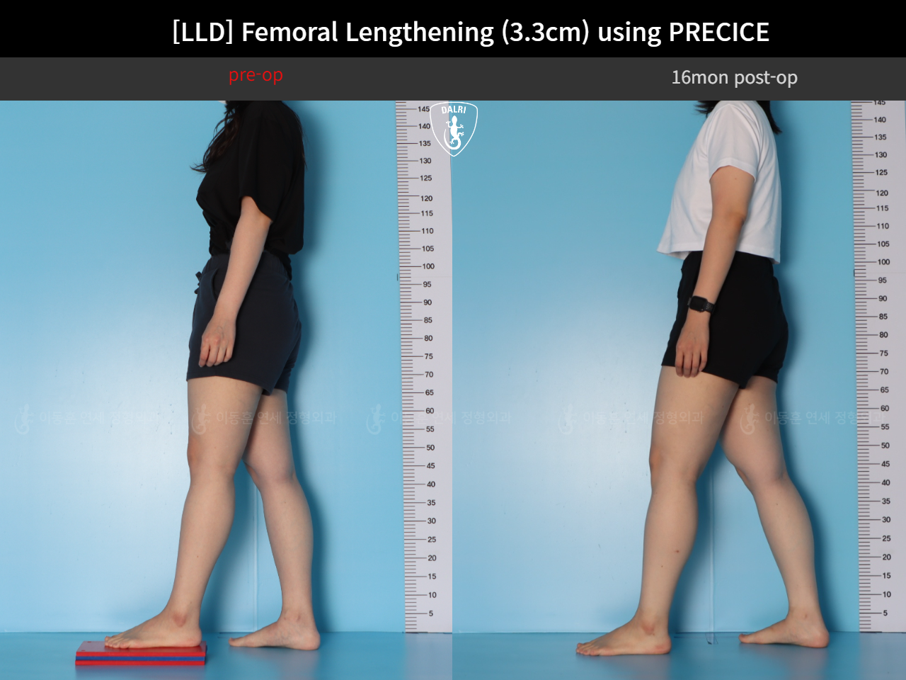 Before and after adult lld, case 125639660, image 3, Dr. Donghoon institute (DALRI)