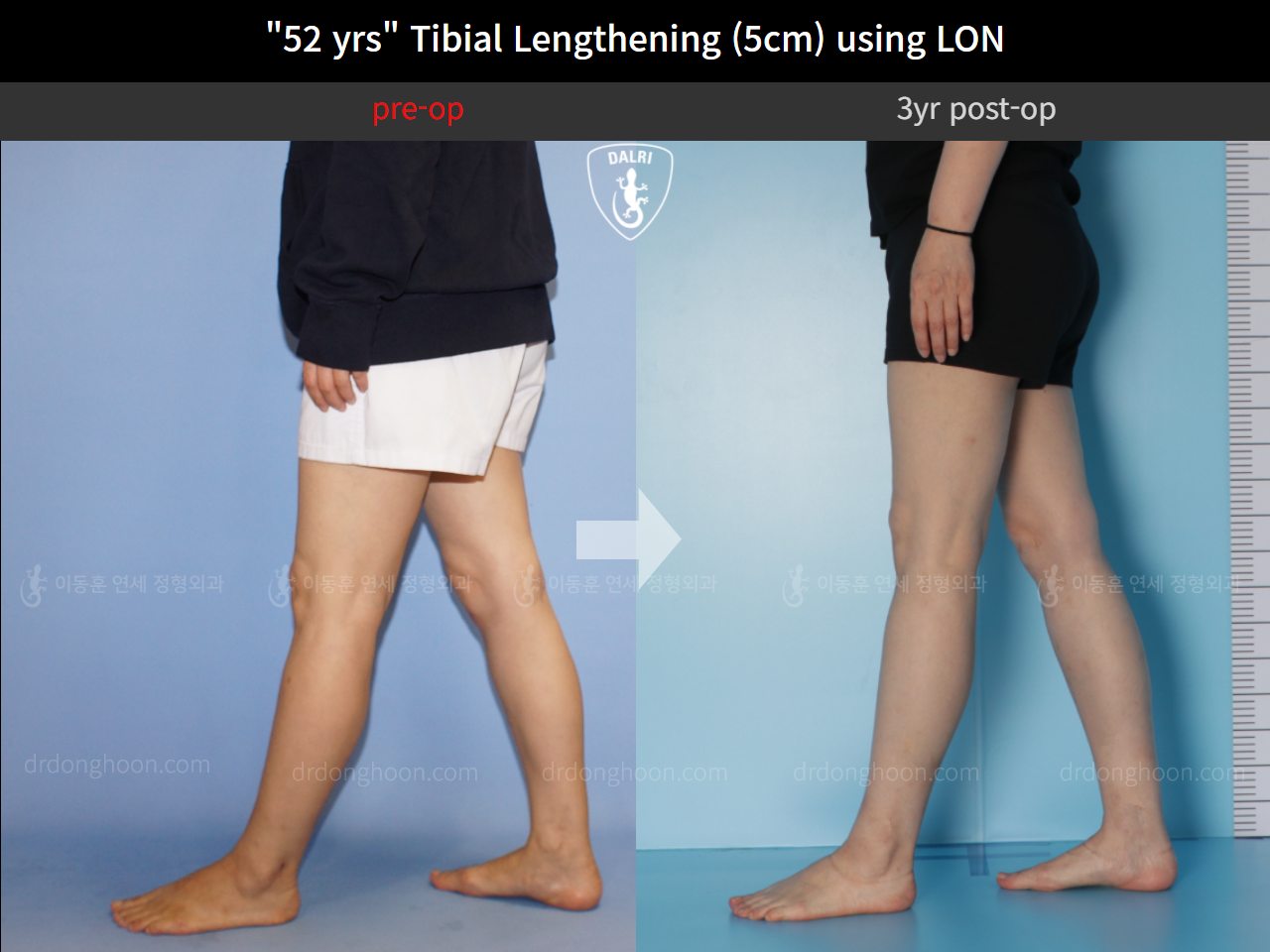 Before and after cll lon, case 9977769, image 7, Dr. Donghoon institute (DALRI)