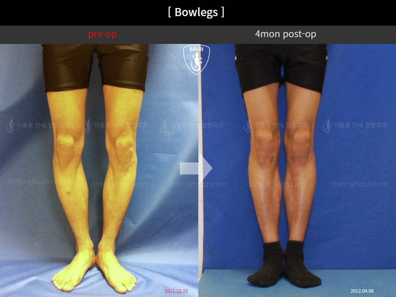 Before and after adult bowlegs, case 11078046, image 2, Dr. Donghoon institute (DALRI)