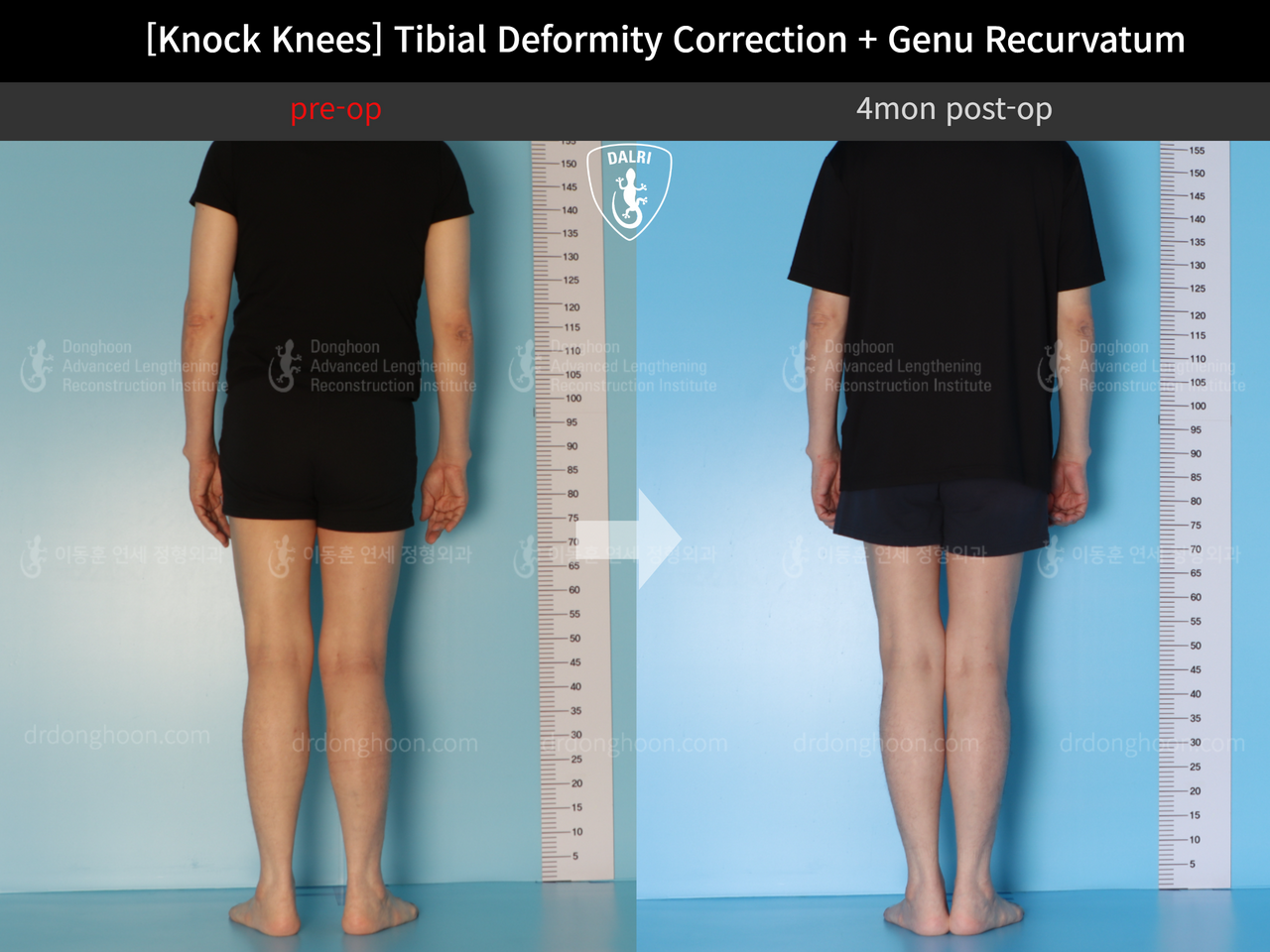 Before and after adult knock knees, case 12846255, image 2, Dr. Donghoon institute (DALRI)