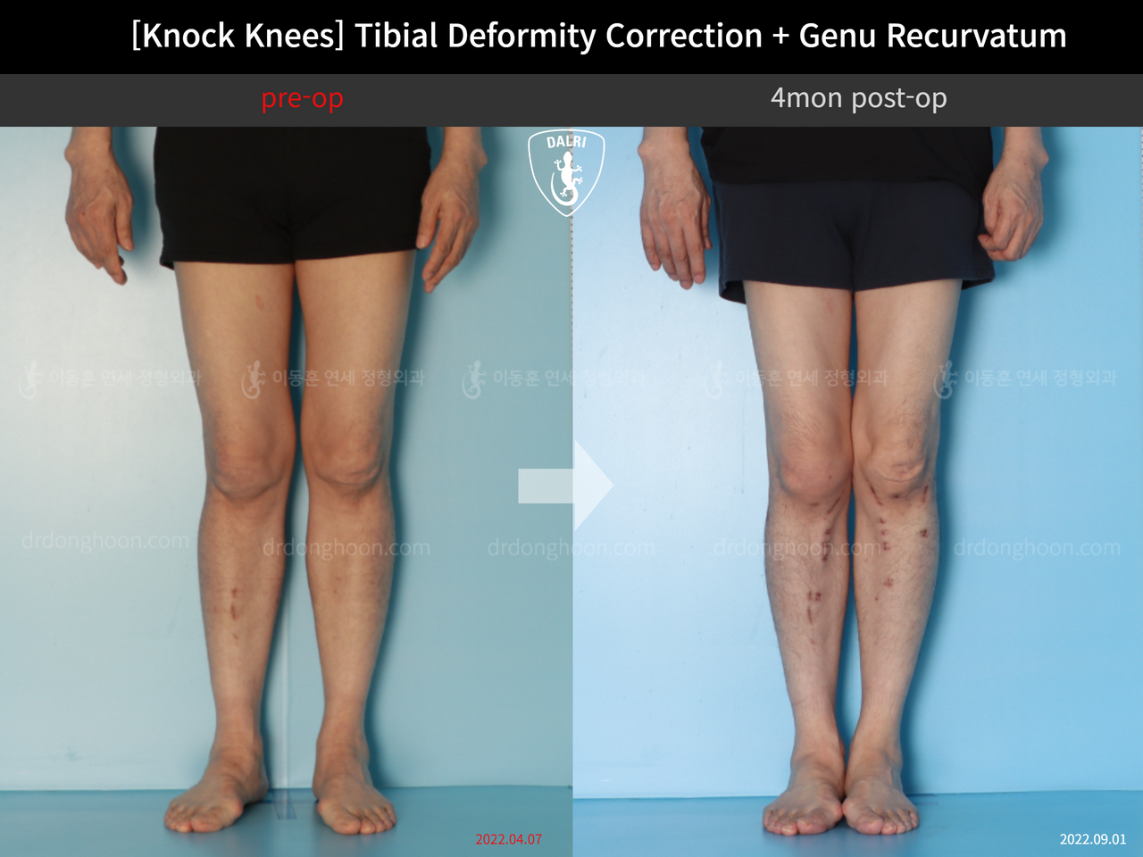 Before and after adult knock knees, case 12846255, image 4, Dr. Donghoon institute (DALRI)