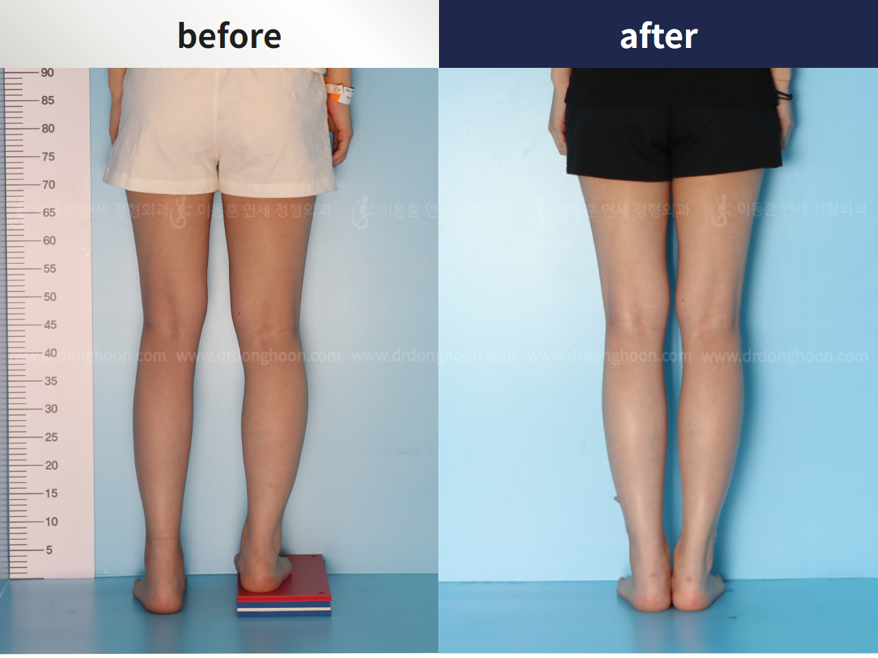 Before and after re-operation for cll, case 4528255, image 7, Dr. Donghoon institute (DALRI)