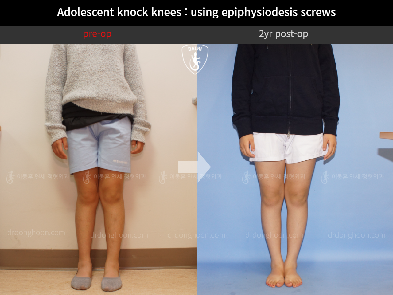 Before and after paediatric & adolescent knock knees, case 4640518, image 3, Dr. Donghoon institute (DALRI)