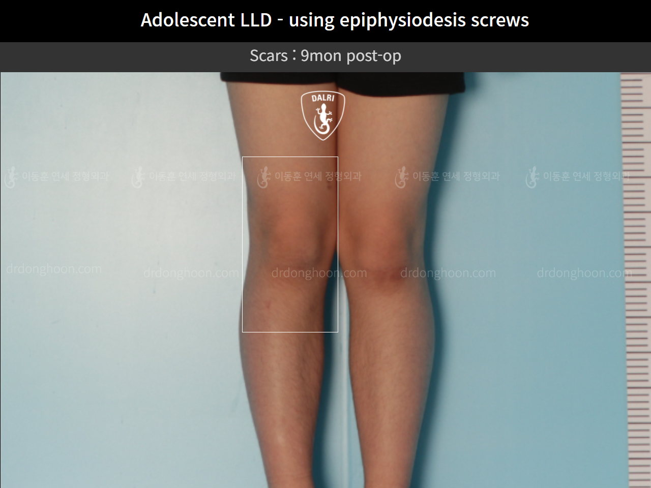 Before and after paediatric & adolescent lld, case 9572577, image 5, Dr. Donghoon institute (DALRI)