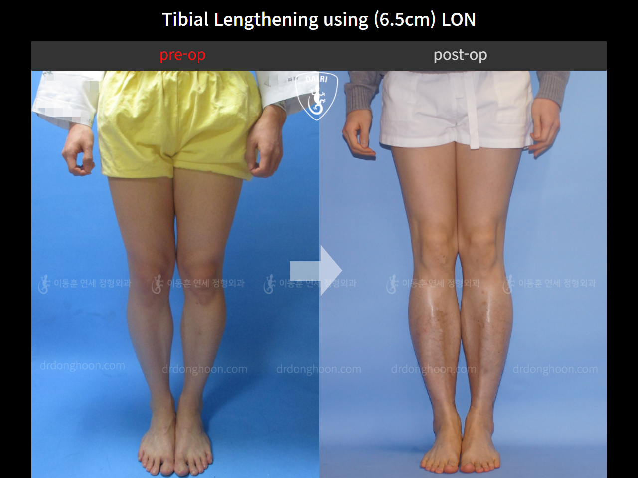 Before and after cll lon, case 4323483, image 3, Dr. Donghoon institute (DALRI)