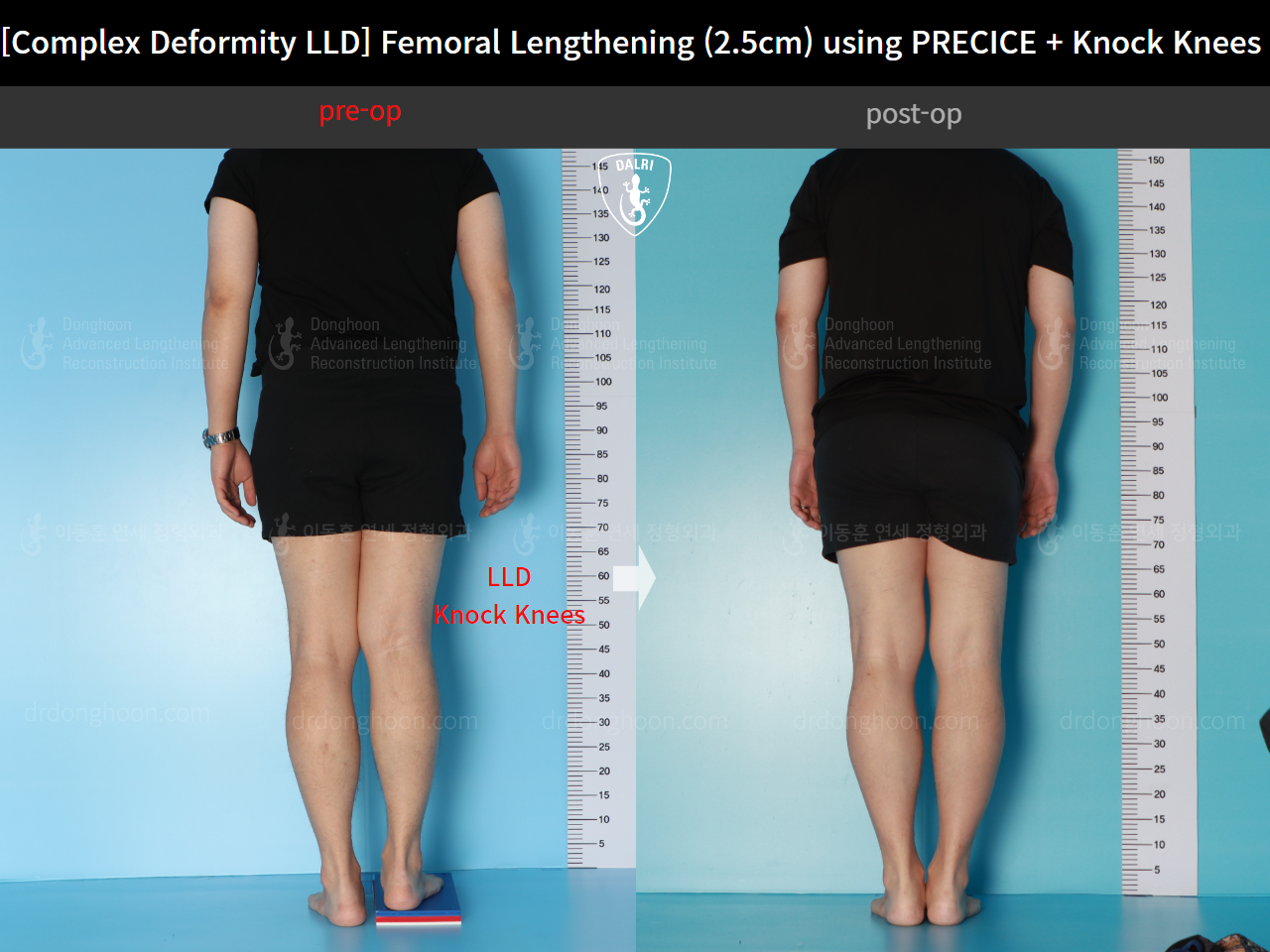 Before and after adult lld, case 17589131, image 2, Dr. Donghoon institute (DALRI)