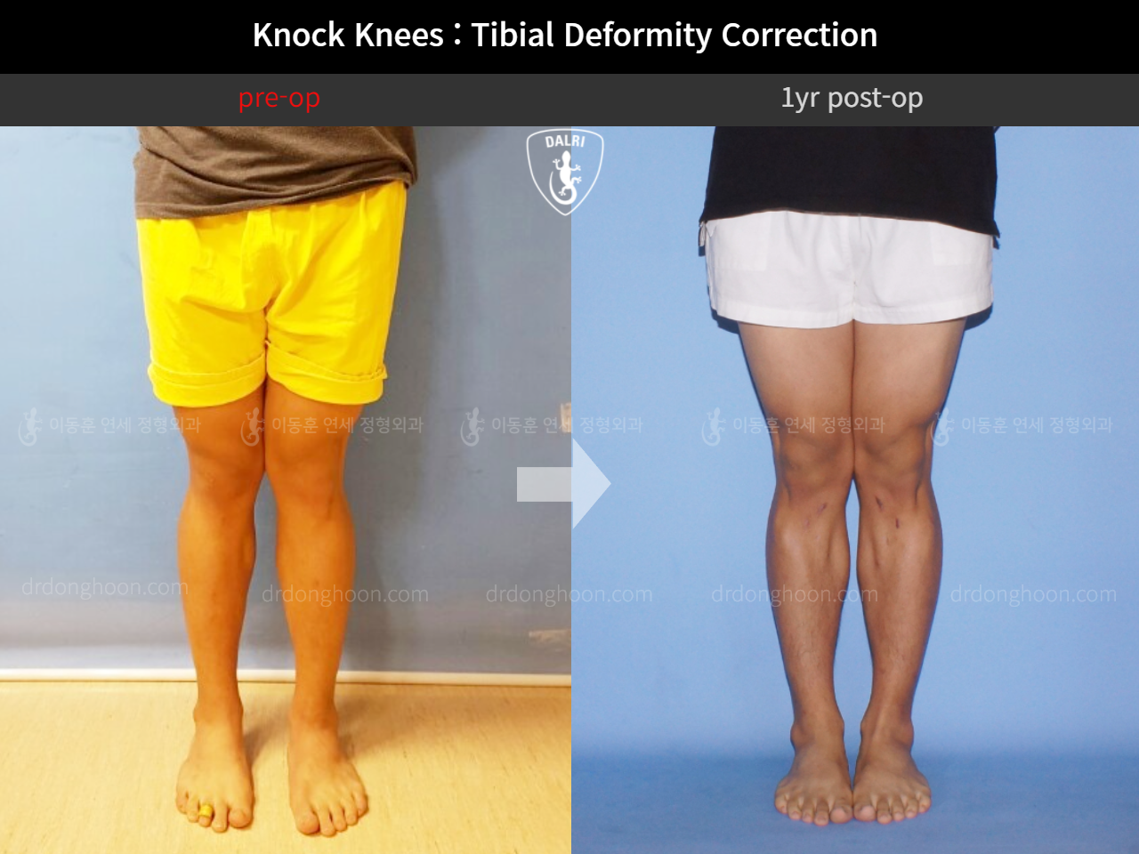 Before and after adult knock knees, case 11468369, image 3, Dr. Donghoon institute (DALRI)