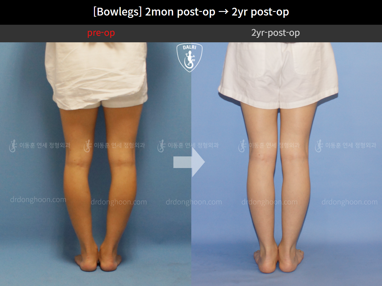 Before and after adult bowlegs, case 4311373, image 6, Dr. Donghoon institute (DALRI)