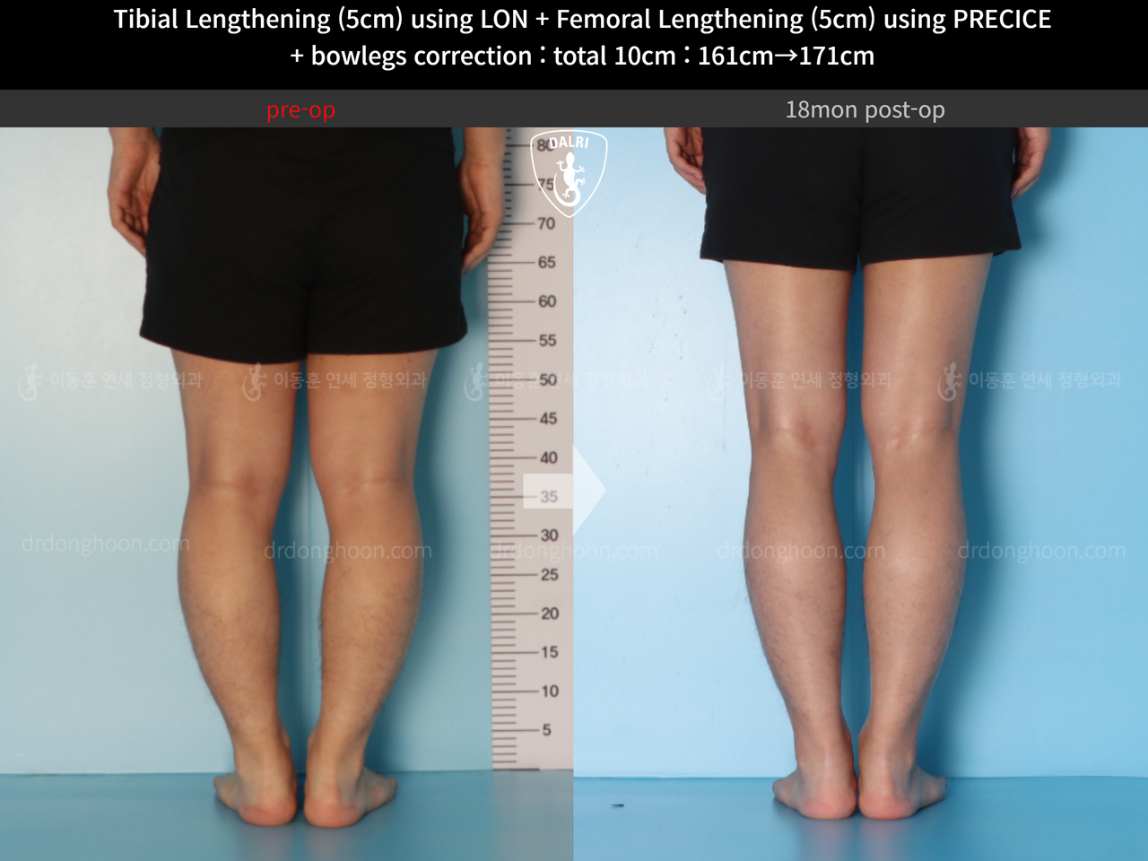 Before and after cll + deformity correction, case 13660857, image 8, Dr. Donghoon institute (DALRI)