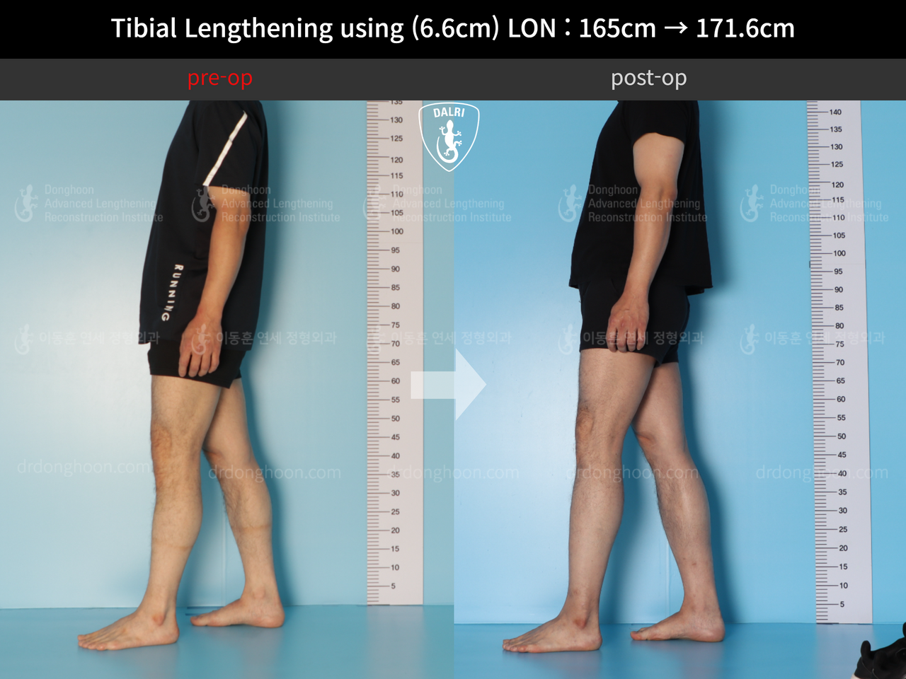 Before and after cll lon, case 12679338, image 4, Dr. Donghoon institute (DALRI)